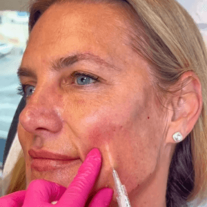 Biostimulator JAW/CHEEKS/CHIN