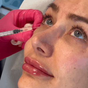 Eye Rejuvenation