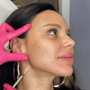 Mommy’s Little Lift (Jawline)