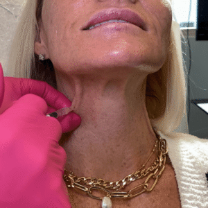 Bye Bye Bands (Platysma Bands)
