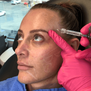 Summer Contour Special | Temple Filler + Masseter Toxin