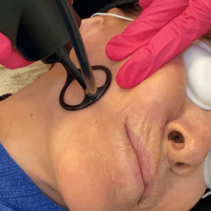 C02 Laser Treatment (The Refine)