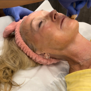 The Renewal Ritual (Facial Peel)