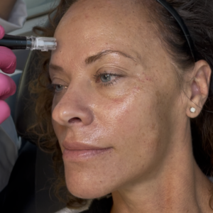 VAMPire Facial (Advanced Microneedling)
